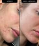 Produktbild 4 von 5, The INKEY List Blemish Clearing Moisturizer Gesichtscreme