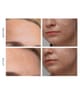 Produktbild 4 von 5, FOREO KIWI™ Lichttherapiegerät