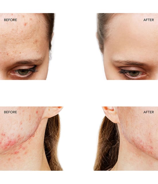 Produktbild 5 von 6, FOREO ESPADA™ 2 Gesichtspeeling