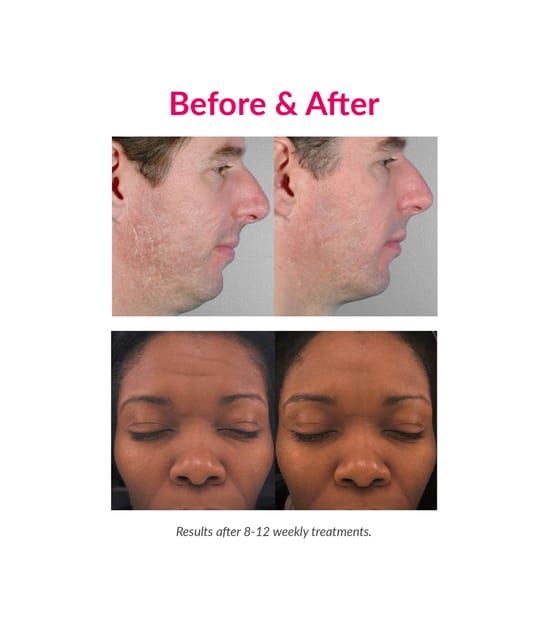 PMD Personal Microderm Pro Microdermabrasion 1 Stk 811485030211 visual-shot_de