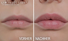Walberg Lip Injection lipinjection ergebnis